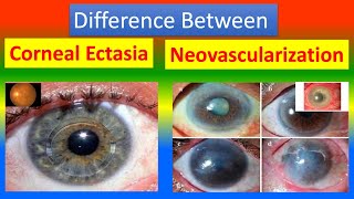 Difference Between Corneal Ectasia and Neovascularization [upl. by Baecher435]