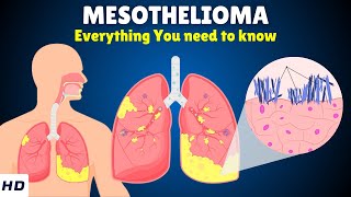 Mesothelioma – Causes Signs and Symptoms Diagnosis amp Treatment [upl. by Hathcock]