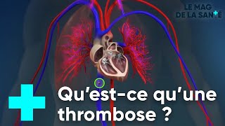 La thrombose veineuse  Le Magazine de la Santé [upl. by Leeann]