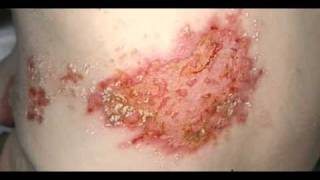 What Causes Shingles [upl. by Piks]