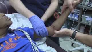 Posterior Elbow Dislocation Reduction [upl. by Orsay]