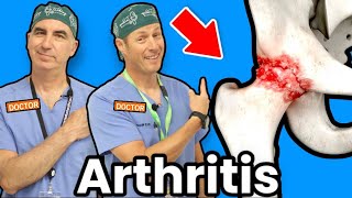 Treating Hip Arthritis Without Surgery [upl. by Tloh263]