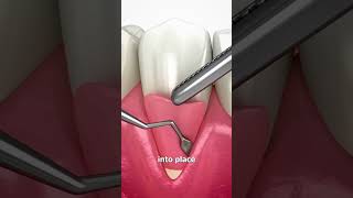 Dental Hygienist reacts and explains reaction gumrecession shorts [upl. by Queridas]