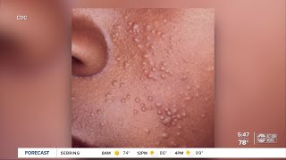 Local pediatrician advises parents on treating molluscum viral skin infection common with kids [upl. by Lanaj]