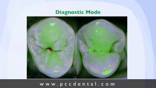 Ask Gordon caries detector for occlusal caries [upl. by Rojas357]