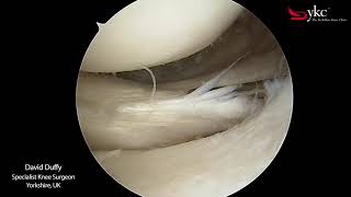 Watch a Knee Surgeon Treat a Meniscal Tear [upl. by Russi]