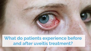 What do patients experience before and after uveitis treatment [upl. by Arihay]