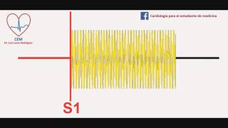 Soplo de la insuficiencia mitral [upl. by Audwin479]