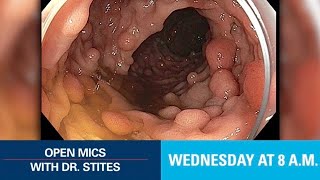 Open Mics with Dr Stites  Familial Adenomatous Polyposis [upl. by Mauer]