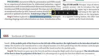 Obstetrics Internal version podalic second twin breech pregnancy delivery [upl. by Lehsreh20]