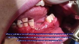 Vape pen explodes shattering teenagers jaw and knocking out some teeth [upl. by Joacimah397]