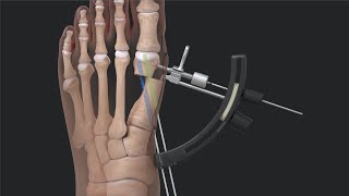 Arthrex Minimally Invasive Bunionectomy System Surgical Technique [upl. by Kendall632]