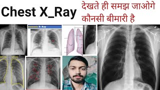 Chest XRay XRay Xray reading pneumonia Lungs Effusion  XRay Technician DoctorMBBS [upl. by Subocaj]