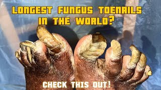 Extremely fungal thickened toenails I Onychogryphosis Transformation Trust Your Podiatrist [upl. by Ahsiekyt]