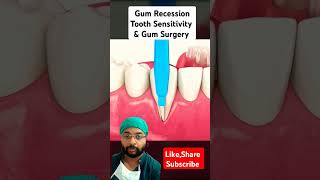 Gum Surgery Animationyt shorts gumsurgery gumrecession sensitivity dentalanimation3d [upl. by Junie]