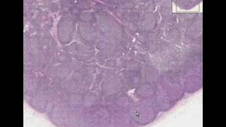 Histopathology Lymph node  Follicular hyperplasia [upl. by Katalin]