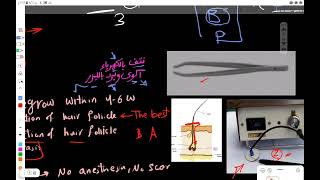 Trichiasis amp Entropion amp Ectoropion Disorders of lid lashes amp Lid margin Ophthalmology رمد [upl. by Bertha]