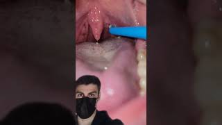 Using A WATER PIK To Remove Tonsil Stones [upl. by Einna]