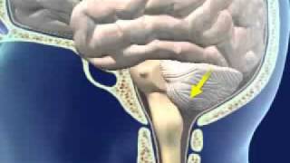 Brainstem Herniation [upl. by Duile]