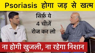 Psoriasis Treatment Without Medicine  Skin Psoriasis  Skin Disease  Himanshu Bhatt [upl. by Oniger]