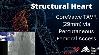 CoreValve TAVR 29mm via Percutaneous Femoral Access Structural Heart Live Cases  April 2015 [upl. by Hartzel]