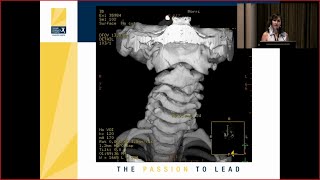 Atlantoaxial C1 C2 Subluxation in the Pediatric Population [upl. by Grounds]