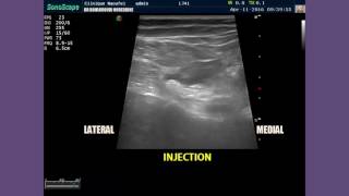 Ultrasound Guided Popliteal Sciatic Nerve Block and sonoanatomy of the popliteal fossa [upl. by Dirraj]