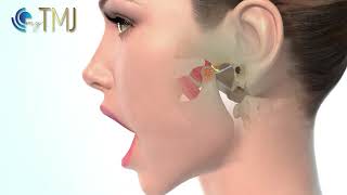 Jaw Popping TMJ Subluxation [upl. by Onig]