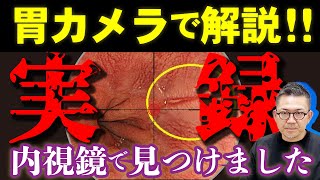 【実際の胃カメラ映像で解説‼︎】普段見られない検査の全貌！胃がんや食道がん、胃カメラ検査でこうして見つけます。 教えて久津川先生 No276 [upl. by Euqinemod]