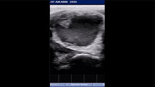 THYROID CYST ultrasound hormones thyroid [upl. by Latona488]