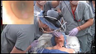 Inhalation Induction Apneic Intubation in a distorted airway from AOD [upl. by Gibbs]