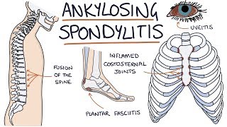 Ankylosing Spondylitis Visual Explanation for Students [upl. by Nnyllaf114]