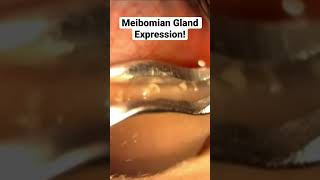 Meibomian Gland Expression MGD shorts [upl. by Natika312]