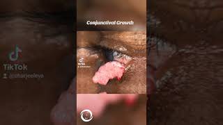 Conjunctival Growth [upl. by Verner]