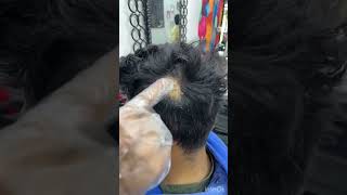 Hair alopecia treatment 🥸💪❤️ hiphop dance haircut alopeciaareatatreatment hairlosstreatment [upl. by Sabella]