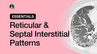 Reticular amp Septal Interstitial Patterns  Chest Radiology Essentials [upl. by Vacuva]