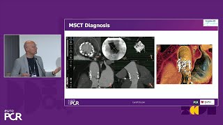 Identification and treatment of subclinical transcatheter valve thrombosis  EuroPCR 2024 [upl. by Ailemak308]