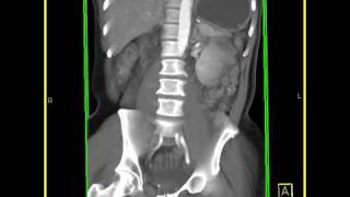 Abdomen Small Bowel Carcinoid tumor of the small bowel VRT images [upl. by Zuleika]