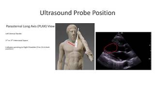 Parasternal Long Axis View Perioperative amp Critical Care ECHO POCUS [upl. by Acirat693]