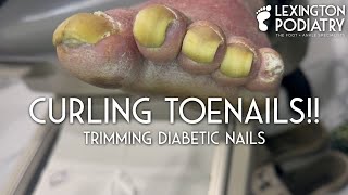 Curling Toenails Trimming Diabetic Nails [upl. by Hamal]