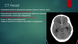 Subarachnoid Hemorrhage [upl. by Suivatnom]