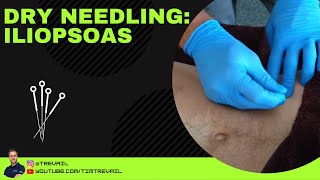 Dry Needling Iliopsoas [upl. by Nerraj]