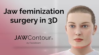 JAWContour®  3D Precision in Jaw and Chin Feminization Surgery [upl. by Jacinto]