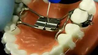 Bracesquestionscom  Orthodontic Jaw Expander How to Turn [upl. by Halstead]