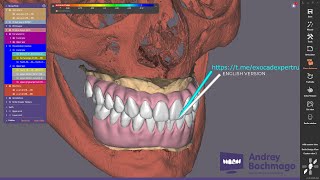 case report №1 FP3 exocad design for implant planning and immediate loading english [upl. by Inaflahk]