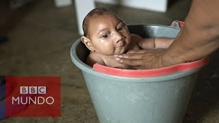 Zika ¿Cómo es la vida del bebé con microcefalia de esta famosa foto [upl. by Ryan723]