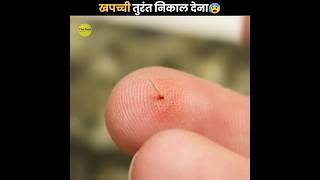 Splinter को तुरंत निकाल देना 😰  Remove Splinter Immediately  The Fact  shorts ytshorts [upl. by Lennahc530]