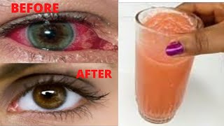 This Drink Whiten The Whites Of Your Eyes Naturally │ Get Rid of Dull Red Eyes │Clear White Eyes [upl. by Nylhsoj]