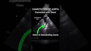 Coarctation Of Aorta corrected with Stent echocardiography for Beginners cardiology echo [upl. by Kreis]