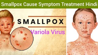 Smallpox Variola Cause Symptoms Diagnosis Treatment in Hindi  Smallpox Hindi  What is Smallpox [upl. by Culhert478]